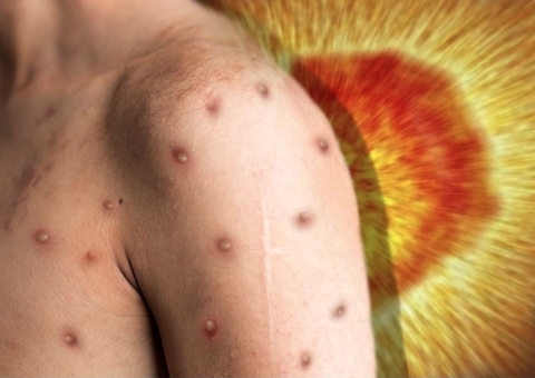 Amazonas chega a 12 casos suspeitos de varíola dos macacos