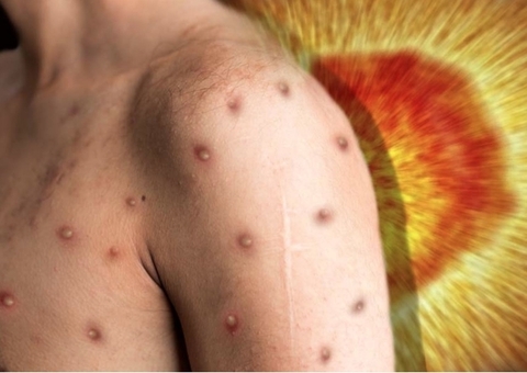 Amazonas chega a 245 infectados pela varíola dos macacos 