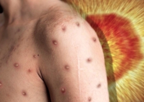 Vacina contra a varíola dos macacos deve chegar ao Brasil este mês