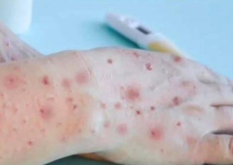 Quinto caso de varíola dos macacos é confirmado no Amazonas