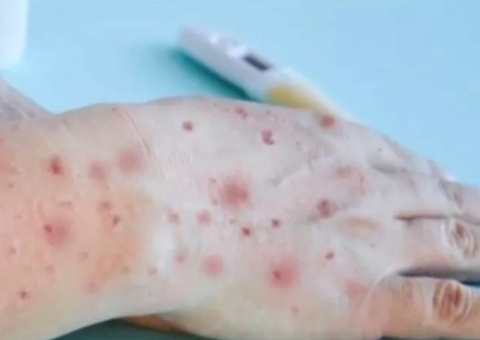 Amazonas registra três novos casos suspeitos de varíola dos macacos