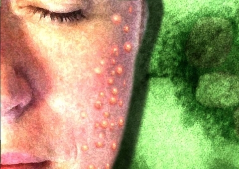 OMS estuda mudar o nome da varíola dos macacos ou monkeypox