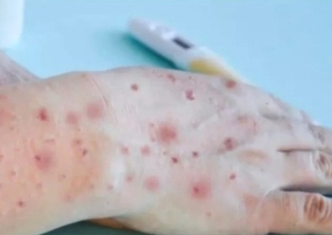 Mais 5 casos de varíola dos macacos são confirmados e Amazonas totaliza 27 infectados