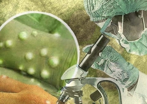 Amazonas registra mais 5 casos suspeitos de varíola dos macacos