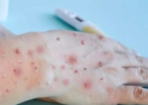 Saúde orienta sobre como prevenir infecção por varíola dos macacos no Amazonas