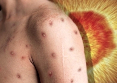 Amazonas chega a 191 casos de varíola dos macacos nesta quinta-feira