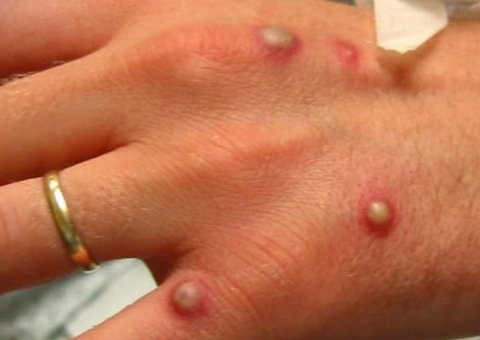 OMS declara varíola dos macacos como emergência global