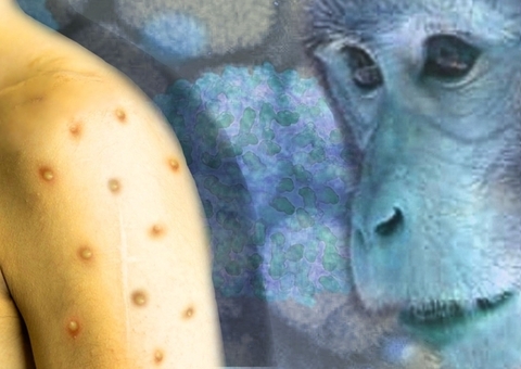 Amazonas zera casos suspeitos e varíola dos macacos é descartada no Estado