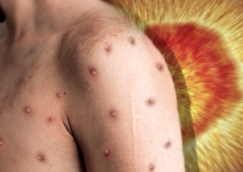 Com mais 10 infectados, Amazonas chega a 334 casos de varíola dos macacos