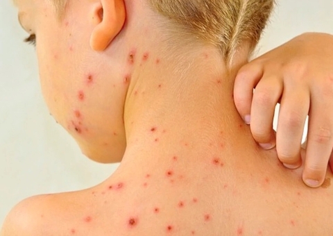 FVS esclarece que casos em escolas de Iranduba são de catapora, e não Mpox