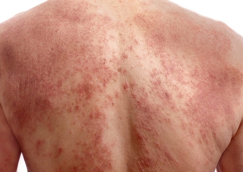 Surto de coceira em Pernambuco é desvendado por médicos