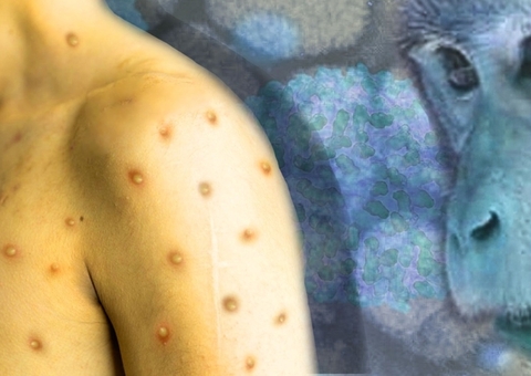 SES-AM divulga comunicado de risco sobre casos de varíola dos macacos 