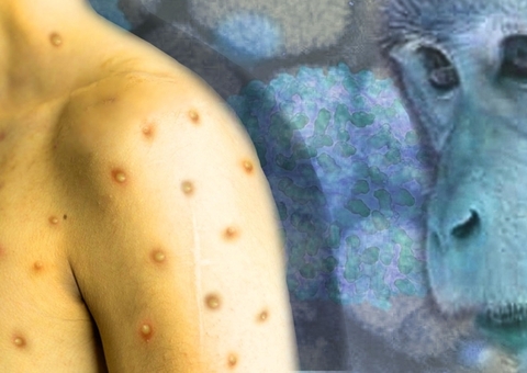 Sobe para 4 os casos suspeitos de varíola dos macacos no Brasil 