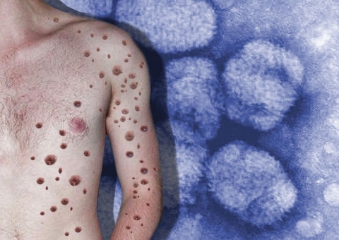 Mais dois casos suspeitos de varíola dos macacos são investigados no Amazonas