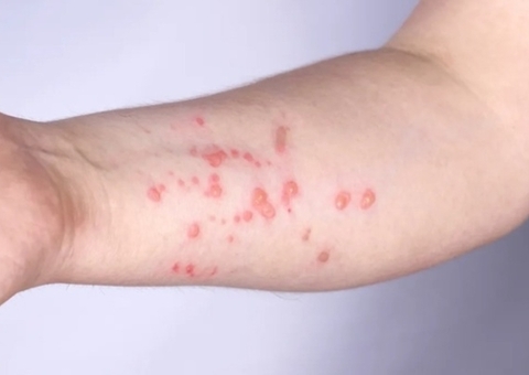 Amazonas tem 33 casos confirmados de Mpox; veja dicas de prevenção