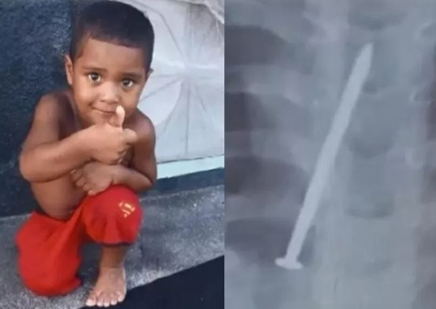 Criança morre após passar um ano com prego no pulmão
