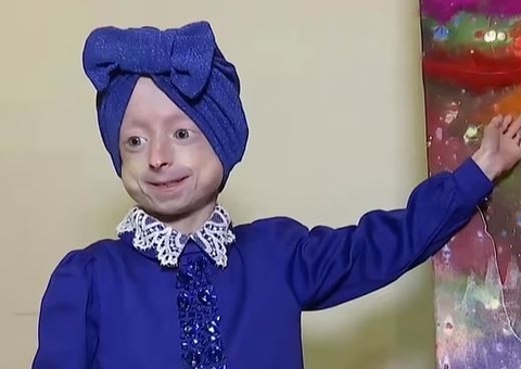 Criança de 10 anos morre de 'velhice' com condição genética rara