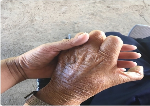 Diagnóstico tardio de Hanseníase eleva risco de mutilações em pacientes no Amazonas