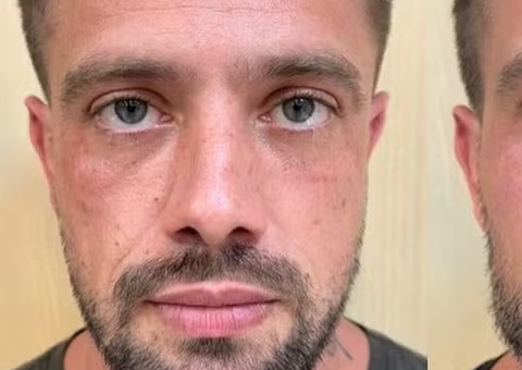 Rafael Cardoso faz harmonização facial e mostra resultado