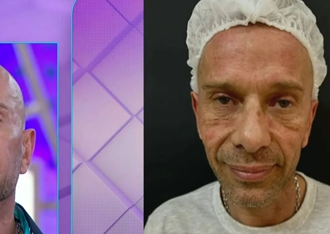 Rafael Ilha impressiona com resultado de harmonização facial 