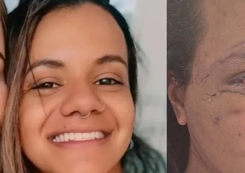 Mulher espancada em elevador mostra o rosto após cirurgia de reconstrução 