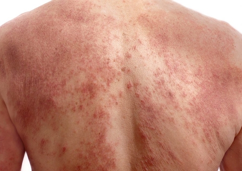 Uso de ivermectina pode ser responsável por surto de sarna, diz estudo 