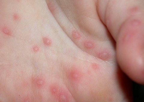 'Mão-pé-boca': 4 estados do Brasil enfrentam surto de vírus altamente contagioso entre crianças