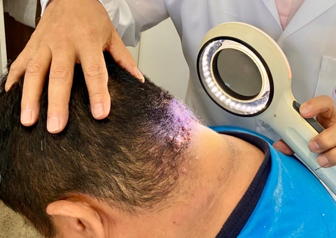 Manaus terá ação para pacientes com suspeita de câncer de pele neste sábado