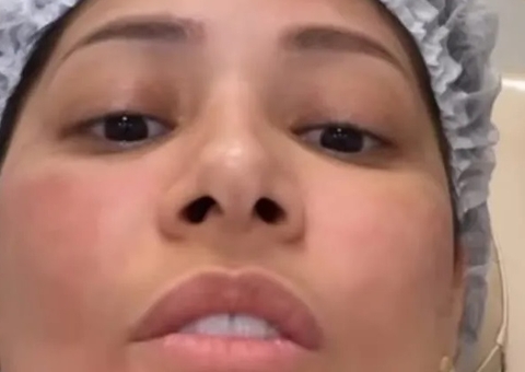 Simaria faz procedimento para retirar papada: ‘cansei de tanta feiura’
