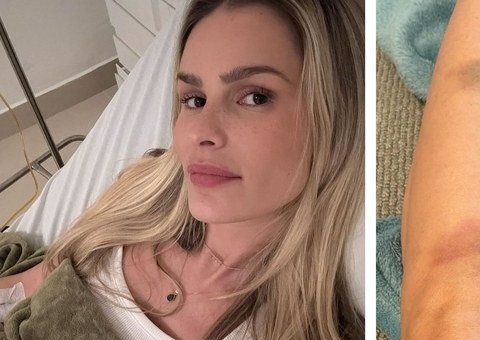 Yasmin Brunet rebate críticas sobre corpo e rosto durante tratamento de lipedema; fotos
