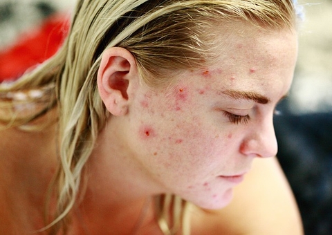 5 dicas que podem te ajudar a tratar as espinhas