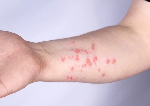 Suécia confirma primeiro caso de mpox