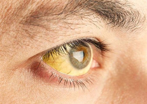 Casos de hepatite têm redução de 54% no Amazonas