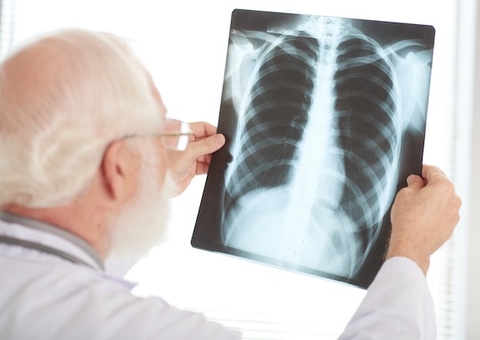 Especialistas alertam para sintomas da tuberculose durante pandemia