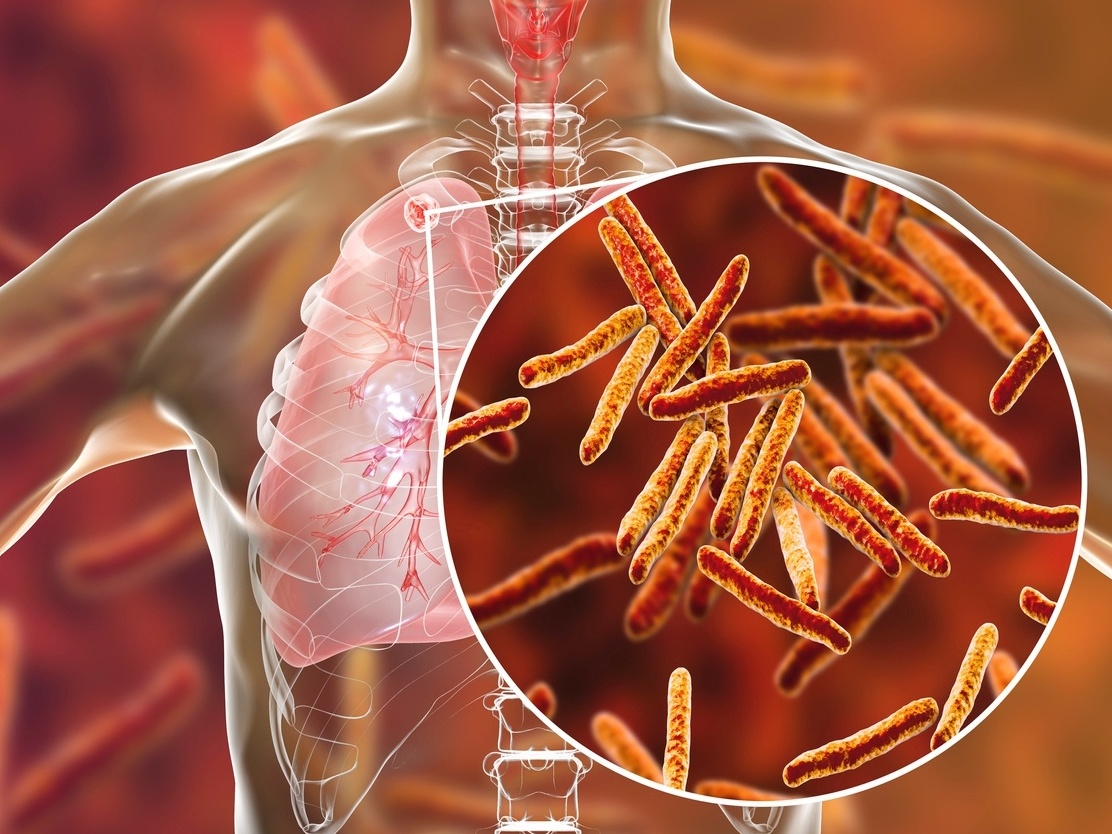 Casos de tuberculose voltam a crescer, e avanço da doença entre mais jovens preocupa