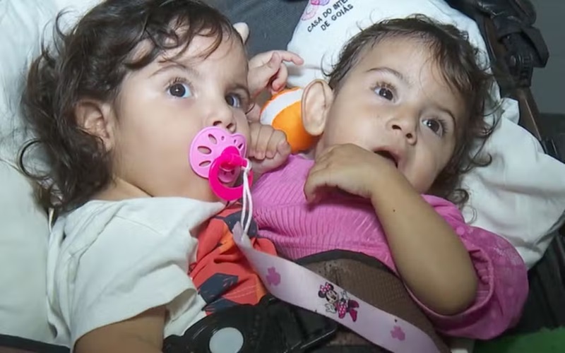 Gêmeas siamesas são separadas em cirurgia no Dia das Mães