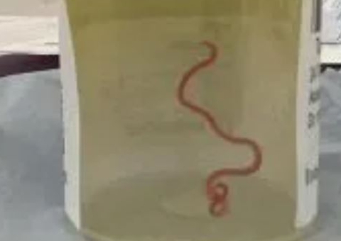 Verme de 8 cm, comum em cobras píton, é achado no cérebro de idosa 