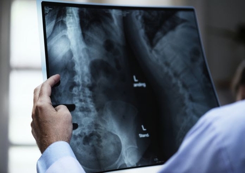 Deficiência de fosfato pode causar problemas ósseos