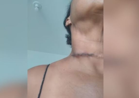 Mulher leva 10 pontos no pescoço após corte com linha de cerol