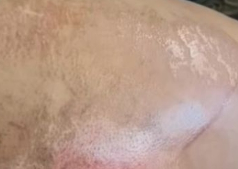 Ex inconformado atropela mulher no momento em que a vítima descia de moto