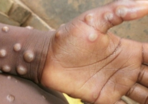 Brasil tem dois casos suspeitos de varíola dos macacos