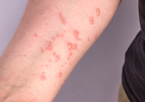 FVS investiga 27 casos suspeitos de varíola dos macacos no Amazonas 