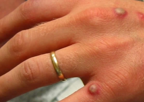 São Paulo confirma 2º caso de varíola dos macacos no Brasil