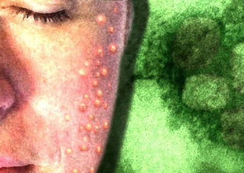 Varíola dos Macacos: Brasil tem 8º caso confirmado 