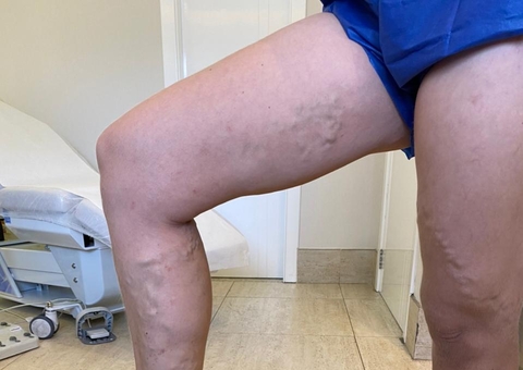 Varizes: Mitos e verdades sobre as inimigas das pernas