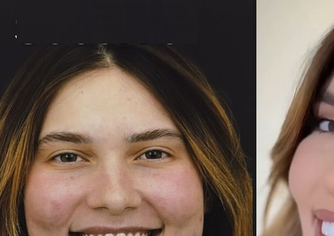 Virgínia Fonseca troca lentes dos dentes e mostra resultado 