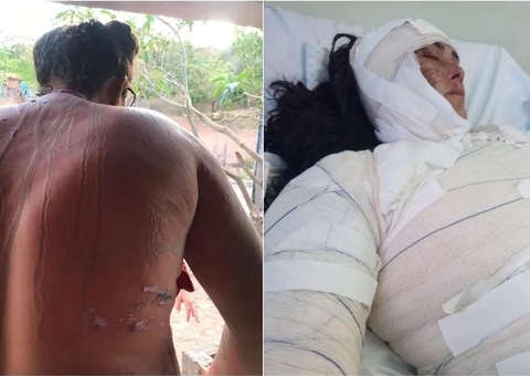 Homem é preso por jogar ácido em corpo de mulher após briga com marido dela