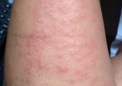 Surto de lesões na pele e coceira intrigam médicos em Pernambuco; Confira