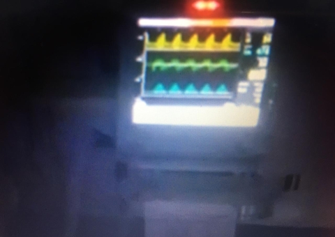 Trabalhadores de folga vão a hospital para ventilar manualmente pacientes