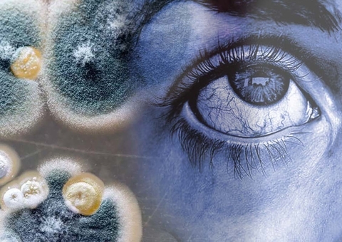 Mais 3 casos de Mpox são confirmados no Amazonas; Manaus lidera ranking